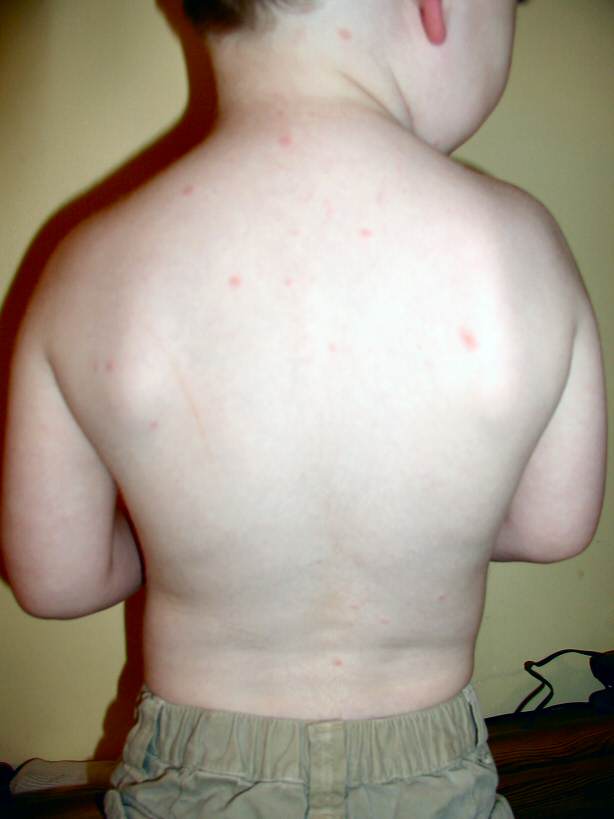 Diagnosing chickenpox