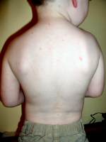 Alex with chickenpox